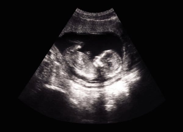 Fetus ultrasound